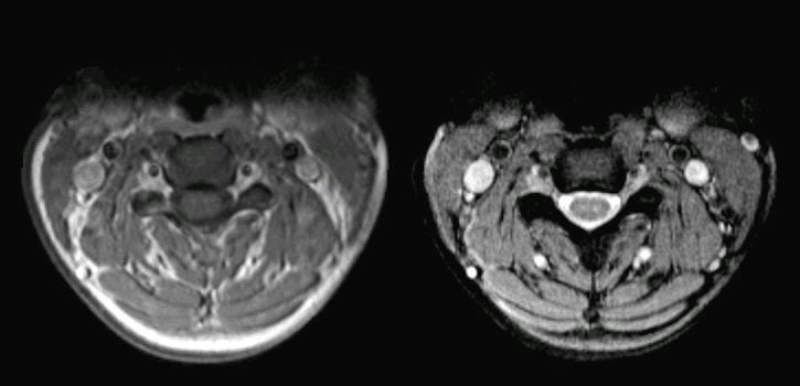 Normal Cervical Spine Axial Mri Hot Sex Picture 4633